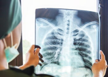 टीबी की आशंका पर अब एक्स-रे अनिवार्य, स्वास्थ्य विभाग ने जारी किए सख्त निर्देश