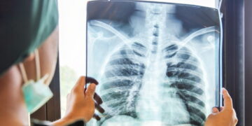 टीबी की आशंका पर अब एक्स-रे अनिवार्य, स्वास्थ्य विभाग ने जारी किए सख्त निर्देश