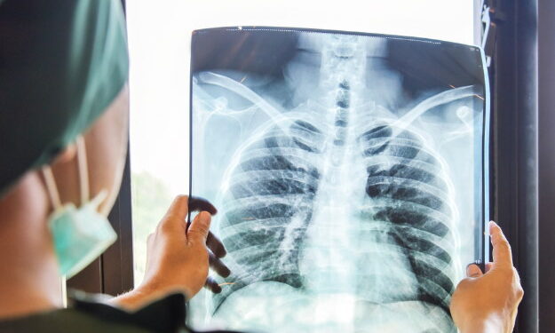 टीबी की आशंका पर अब एक्स-रे अनिवार्य, स्वास्थ्य विभाग ने जारी किए सख्त निर्देश